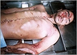 ISRAEL: Body Parts and Bio-Piracy